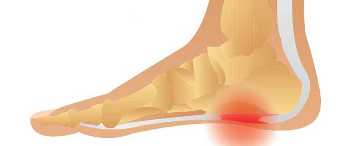 سوزش کف پا چه عللی دارد و چطور درمان می‌شود؟ - ورزش درمانی