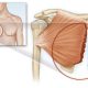 درمان پارگی عضله سینه‌ای- ورزش درمانی