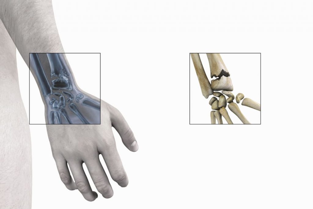 علائم و درمان شکستگی مچ دست کالیس - ورزش درمانی مقاله بدنسازی