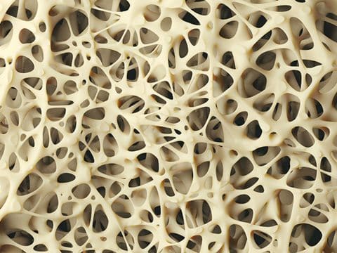 پوکی استخوان و 6 باور رایج غلط - ورزش درمانی مقاله بدنسازی